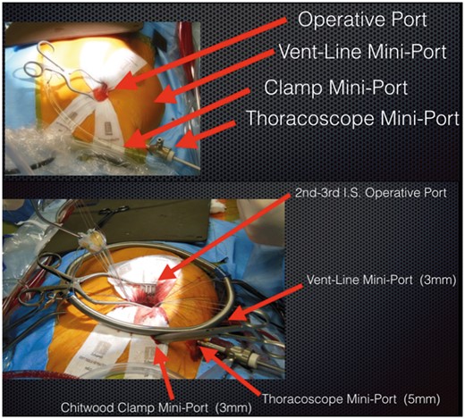 Operating field set-up.