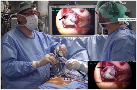 Right coronary sinus (black arrows) is surgically difficult to manage.