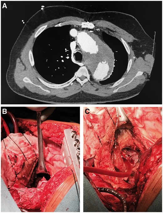 (A) Preoperative chest computed tomography angiography: aneurysm. (B) Stent graft firmly adhered. (C) Part of stent graft.