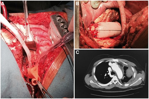 (A) Proximal anastomosis. (B) Distal anastomosis. (C) Postoperative chest computed tomography angiography: successful repair.
