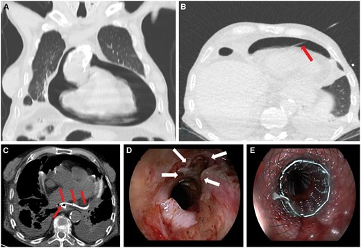 An 84-year-old man presented with cardiogenic shock. A computed tomography scan revealed a massive pneumopericardium (A), and an emergency computed tomography-guided drain (red arrow, B) evacuated air and turbid fluid. An oral-contrast computed tomography scan detected a pericardial opacification through an oesophagopericardial fistulation (red arrows, C) of a previously unknown oesophageal tumour, as subsequently confirmed at endoscopy (white arrows, D). A coated expandable metal stent was placed (E), but, despite intensive care therapy, the patient died 4 days later due to uncontrolled sepsis.