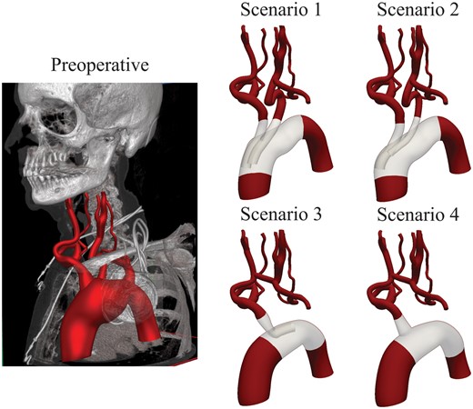 Geometric models of the preoperative situation and 4 endovascular repair scenarios.