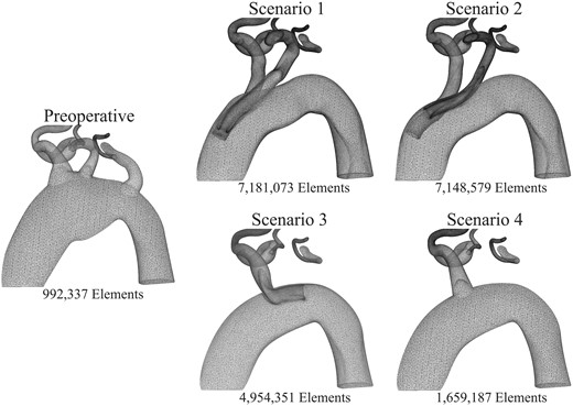 Computational mesh refinement near the supra-aortic arteries in the preoperative anatomy (left) and in the 4 endovascular repair scenarios (right). Mesh refinement is needed to capture complex haemodynamics around the inner branches. Therefore, the postoperative cases have computational meshes with more elements, leading to higher computational costs.
