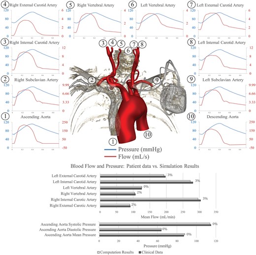 Top: pressure (blue lines) and flow (red lines) waveforms at the inlet (ascending aorta) and all outlets of the preoperative model. The location of each measurement is denoted by a number. Bottom: comparison between measured and computed blood flows and pressures in the preoperative model, with percentage differences between the 2 shown.
