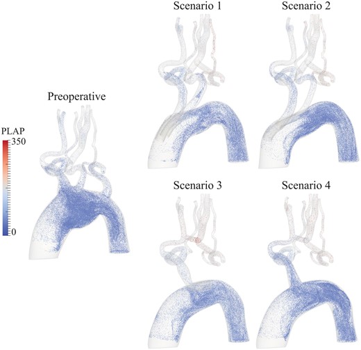 The image visualizes the position and PLAP values, representing the amount of accumulated blood shear rate, of particles 2.4 s after virtual injection at the ascending aorta for all scenarios. All postoperative scenarios show elevated values of shear rate in the supra-aortic arteries compared to the preoperative situation. Furthermore, Scenarios 3 and 4 present higher values of blood shear rate in the cervical arteries compared to Scenarios 1 and 2. PLAP: platelet activation potential.