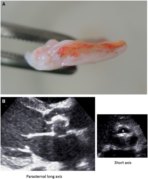 (A) An image of an explanted bovine pericardial patch with marked proliferation (white) surrounding the initial patch (yellow). (B) An echocardiographic image of a thickened valve leaflet (asterisks).