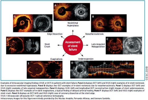 Intracoronary imaging for the assessment of stent failure.