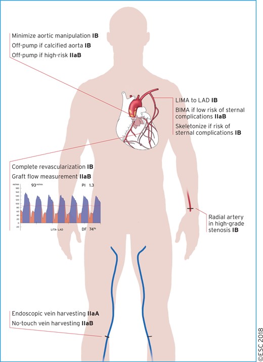 Technical aspects of CABG. BIMA: bilateral internal mammary artery; CABG: coronary artery bypass grafting; IMA: internal mammary artery; LAD: left anterior descending coronary artery.