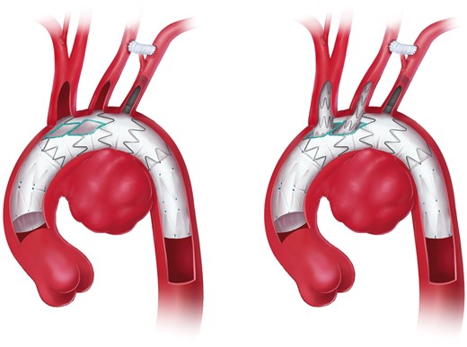 Total endovascular aortic arch repair using the double branch technique (printed with permission from © Campbell Medical Illustration).