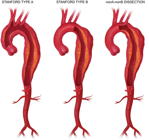 Definitions of aortic dissections (printed with permission from © Campbell Medical Illustration).