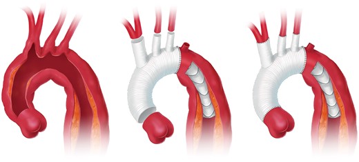 Aortic arch replacement using the frozen elephant trunk technique with the descending anastomosis in zone 2 (printed with permission from © Campbell Medical Illustration).