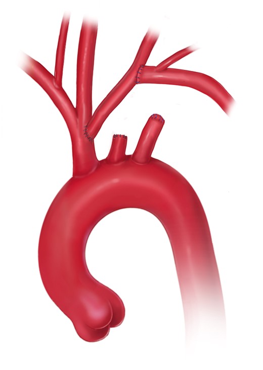 Autologous double transposition of the supra-aortic branches (printed with permission from © Emily McDougall Art).