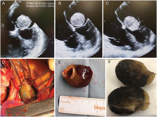 Echocardiogram images showing a mobile giant left atrial mass determining mitral stenosis in a 50-year-old woman with a history of syncope and dyspnoea (A–C). Intraoperative view (D). The mass (E and F) was adjacent to the anterior mitral annulus and was eradicated through a standard direct left atrial surgical approach.