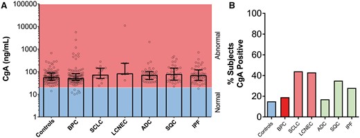 Chromogranin A (CgA) levels in controls and in patients with benign disease and lung neoplasia. (A) CgA stratified by normal (blue) or abnormal (red) in each of the cohorts. No significant differences were evident. The Kruskal–Wallis statistic was 13.6 (P > 0.05). (B) Percentage of CgA positive responses in the different cohorts. In lung disease, a positive CgA response (>108 ng/ml) ranged from 17% to 44%. Neuroendocrine genotype tumours (red); control subjects (blue); non-small-cell lung cancer. ADC: adenocarcinoma; BPC: bronchopulmonary carcinoids; IPF: idiopathic pulmonary fibrosis (green); LCNEC: large-cell neuroendocrine carcinoma; SCLC: small-cell lung cancer; SQC: squamous cell carcinoma.