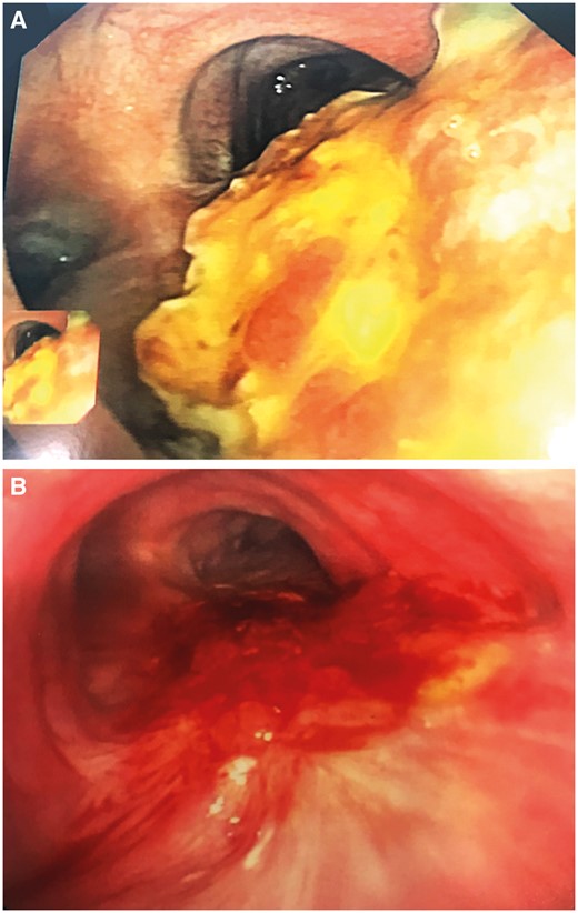 Prophylactic use of hyperbaric oxygen therapy in reconstruction of the membranous wall of the distal trachea with bioprosthetic material. (A) Early postoperative period. (B) Several weeks after surgery showing adequate incorporation and epithelialization of the bioprosthesis.