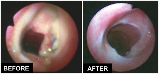 Effect of hyperbaric oxygen therapy on the healing of a tracheal anastomosis with cartilage necrosis but without dehiscence.