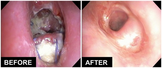 Effect of hyperbaric oxygen therapy on the healing of severe necrosis and partial dehiscence of the airway after a complex tracheo-oesophageal fistula repair.