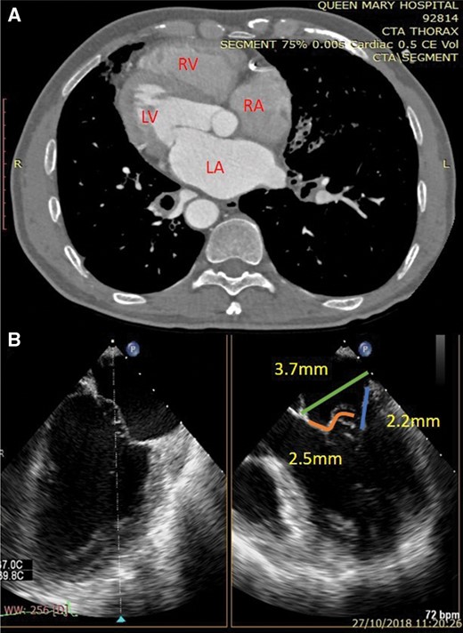 (A) Computed tomography thorax showing dextrocardia with LV apex towards the right side. (B) Preoperative transoesophageal echocardiography biplane view showing mitral valve measurements. LA: left atrium; LV: left ventricle; RA: right atrium; RV: right ventricle.