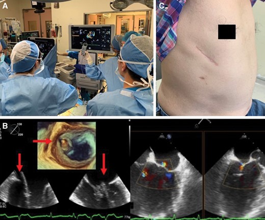 (A) Operating theatre showing the reversed position of surgeons on the right and the main monitor on the left. (B) Intraoperative 2- and 3-dimensional transoesophageal echocardiography showing the device (arrows) grasping the prolapsed segment and mild central regurgitation at the end of the procedure. (C) Right thoracotomy scar at follow-up.