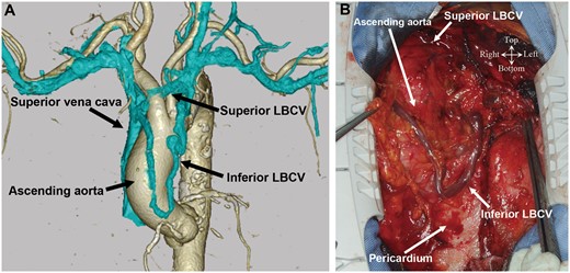 (A) A preoperative 3-dimensional-reconstructed computed tomographic image showing an anomalous double LBCV. (B) The intraoperative image showing the inferior LBCV passing across the heart in front of the pericardium in a 79-year-old woman undergoing aortic valve replacement and coronary artery bypass grafting. LBCV: left brachiocephalic vein.