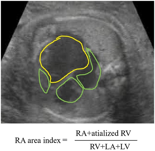 RA area index calculated by echocardiographic measurements. The ratio of the combined area (yellow line) of the RA and the atrialized RV to that of the remaining chambers (3 areas surrounded with green lines) was obtained. LA: left atrium; LV: left ventricle; RA: right atrium; RV: right ventricle.