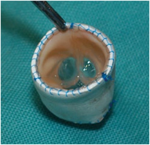 Cylinder valve before implantation. The 12-mm Contegra bovine internal jugular venous valve is trimmed and placed inside a 14-mm Gore-Tex tube graft.