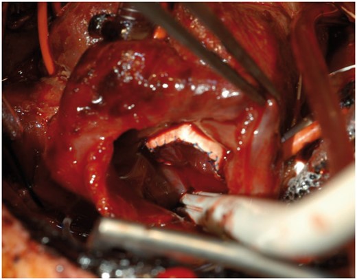 Cylinder valve implanted. View through the right atrium of the valve sutured in place.