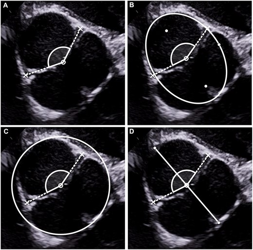 (A) Angle measurement according to coaptation centre. The most central point of the coaptation line is determined; the angle is measured with lines drawn from the coaptation centre through the 2 functional commissures. (B) Angle measurement according to geometric centre determined by the ellipse method. The ellipse is adjusted to accommodate the root shape, yielding the geometric centre of the root. The angle is measured with lines drawn from the geometric centre through the 2 functional commissures. (C) Angle measurement according to geometric centre determined by the circle method. The circle is adjusted to accommodate the root shape. The angle is measured with lines drawn from the centre of the circle through the 2 functional commissures. (D) Angle measurement according to geometric centre determined by the line method. The central line is drawn from the rudimentary commissure to the approximate centre of the non-fused sinus and then cut in half, yielding the geometric centre of the root. The angle is measured with lines drawn from the geometric centre through the 2 functional commissures.