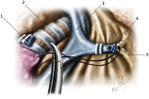 Optimal surgical exposure: (1) posterior stump of the azygos vein; (2) paratracheal tissue; (3) superior vena cava; (4) anterior stump of the azygos vein; and (5) anterior mediastinum.