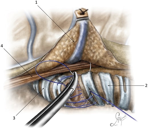 End-to-end tracheobronchial anastomosis: (1) posterior stump of the azygos vein; (2) trachea; (3) left main bronchus; and (4) oesophagus.