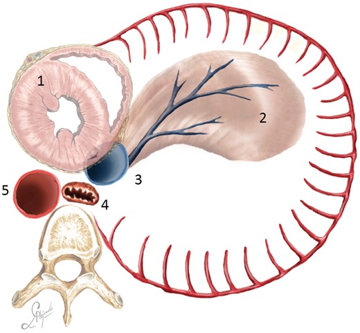 Diaphragmatic flap cutting scheme (bird view): (1) heart; (2) diaphragmatic flap; (3) inferior vena cava; (4) oesophagus; and (5) descending aorta.