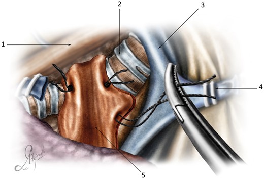 Diaphragmatic flap fixation: (1) oesophagus; (2) trachea; (3) superior vena cava; (4) anterior stump of the azygos vein; and (5) diaphragmatic flap.