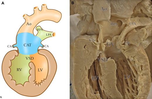 Morphology of the common arterial trunk. Schematic drawing (A) and morphological specimen (B) of the CAT. There is a single-outlet ventriculo-arterial connection with deficient septation at the level of the outflow tract (location of the ventricular septal defect), the level of the arterial valve (truncal valve) and the level of the great arteries. The CAT gives access to the systemic, pulmonary and coronary circulation. Ao: aorta; CA: coronary artery; CAT: common arterial trunk; LPA: left pulmonary artery; LV: left ventricle; RPA: right pulmonary artery; RV: right ventricle: TrV: truncal valve; VSD: ventricular septal defect.