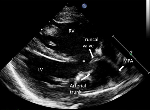 Parasternal long-axis view of a common arterial trunk. The arterial trunk overrides the ventricular septum and the large outlet ventricular septal defect (*). LV: left ventricle; MPA: main pulmonary artery; RV: right ventricle.