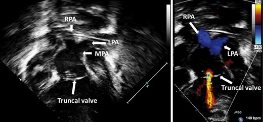Two-dimensional transthoracic echocardiographs with colour Doppler showing the truncal valve and the pulmonary arteries in a neonate with a common arterial trunk. There is mild-to-moderate truncal valve regurgitation. LPA: left pulmonary artery; MPA: main pulmonary artery; RPA: right pulmonary artery.
