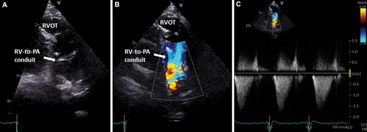 Two-dimensional transthoracic echocardiogram illustrating the RV-to-PA conduit. (A). Colour-guided and Doppler echocardiography shows good RV-to-PA conduit function (B and C). PA: pulmonary artery; RV: right ventricle; RVOT: right ventricular outflow tract.