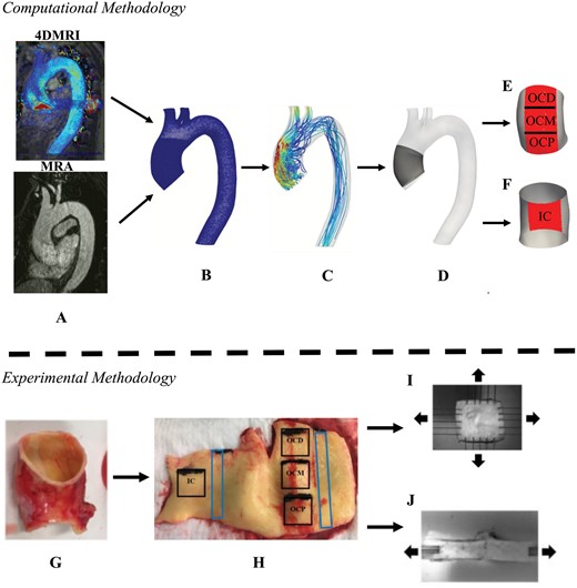 (A) Preoperative magnetic resonance angiogram and four-dimensional magnetic resonance imaging image sequences of the thoracic aorta utilized for computational modelling. (B) Computational mesh derived from magnetic resonance angiogram/four-dimensional magnetic resonance imaging images. (C) Flow field calculated from computational fluid dynamics. The ascending thoracic aortic aneurysm (D) was divided into areas of interests: (E) outer curvature proximal, outer curvature middle and outer curvature distal, and (F) inner curvature. (G) Complete ring of resected aorta. (H) Squares were sampled for (I) bi-axial tensile testing and rectangles were sampled for (J) delamination testing.