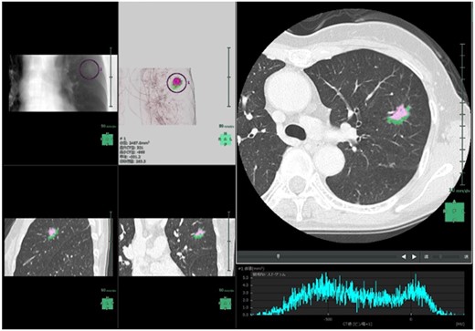 Screenshot of ground-glass nodule/Solid Automatic Identification AI Software Beta Version in the Synapse Vincent system. Pink: solid component; green: ground-glass nodule component.