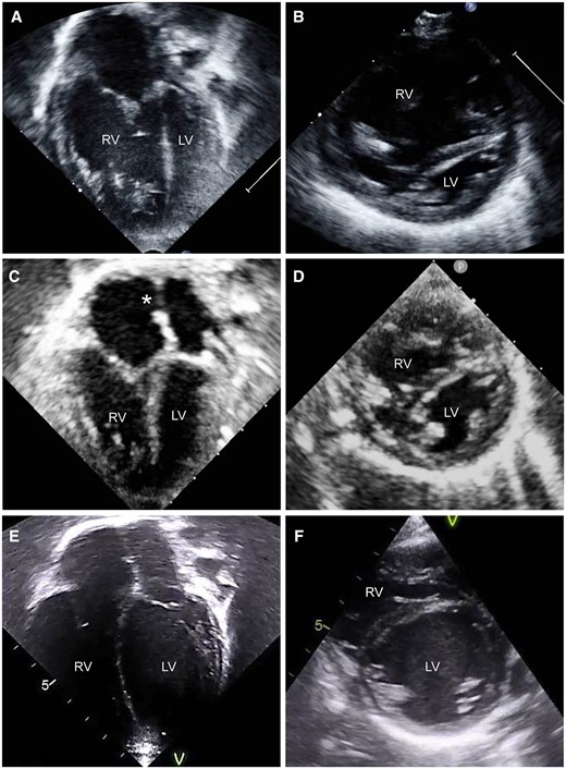 Two-dimensional echocardiogram at the end-diastolic phase, before (A, B) and after (C, D) the atrial septal defect restriction (asterisk), then 3 years after aortic root translocation (E, F). LV: left ventricle; RV: right ventricle.