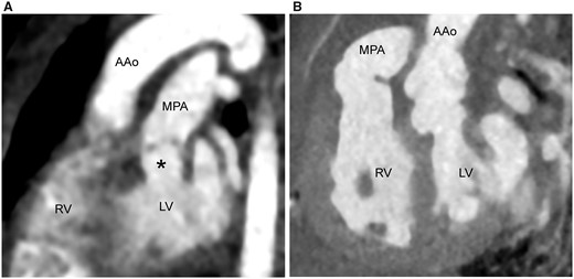 Contrast-enhanced computed tomogram before (A) and after (B) the aortic root translocation. Note the valvular and subvalvular pulmonary stenosis (* the subvalvular diameter of 6.2 mm) on preoperative images (A), which improves after aortic root translocation (the subvalvular diameter of 12.9 mm) (B). AAo: ascending aorta; LV: left ventricle; MPA: main pulmonary artery; RV: right ventricle.