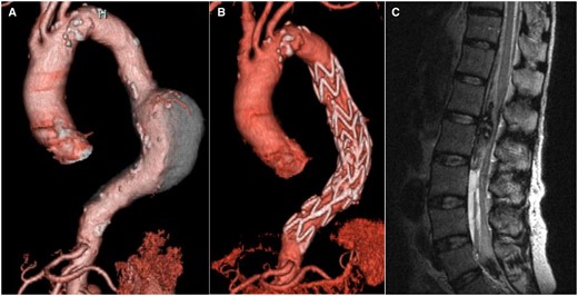 Spinal subdural haematoma. The case of a spinal subdural haematoma is exhibited. (A) Preoperative computed tomography demonstrates the descending thoracic aortic aneurysm. (B) Postoperative computed tomography demonstrates excluded descending thoracic aortic aneurysm with no endoleaks. (C) On magnetic resonance imaging, a spinal subdural haematoma was detected after removal of the cerebrospinal fluid drainage tube 2 days after thoracic endovascular aortic repair.