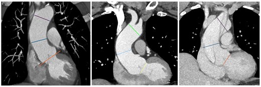 In 3 examples of standard coronal views (left: normal aorta; centre: root phenotype dilatation; right: acute type A aortic dissection), 2D thick-slab mode with volume rendering, the 3 landmark planes that were drawn manually are highlighted (ventriculo-aortic junction—root plane; mid-ascending aorta, level of the pulmonary trunk centre—ascending plane; origin of the brachio-cephalic trunk—arch plane): the angles between their axes (root-ascending angle; ascending-arch angle) were measured by using the Cobb’s angle plug-in.