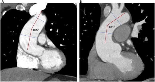 Two examples of aortic dilatations with bicuspid aortic valve: (A) ascending phenotype without Asc-Arch angle narrowing and (B) root phenotype with Asc-Arch angle narrowing.