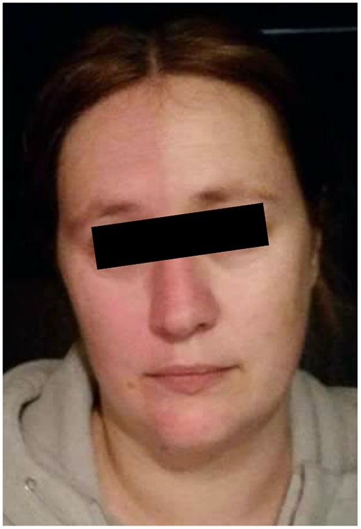 Preoperative photo demonstrating symptomatic Harlequin syndrome.