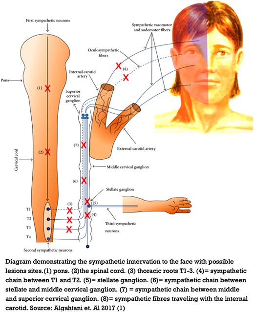 Pathophysiology of Harlequin syndrome. The copyright license permits use, as long as the original work is acknowledged. See below. PMC full text: Case Rep Med. 2017;2017:5342593. Published online 2017 Feb 21. doi: 10.1155/2017/5342593. Copyright/License Request permission to reuse Copyright © 2017 Hussein Algahtani et al. This is an open access article distributed under the Creative Commons Attribution License, which permits unrestricted use, distribution, and reproduction in any medium, provided the original work is properly cited.