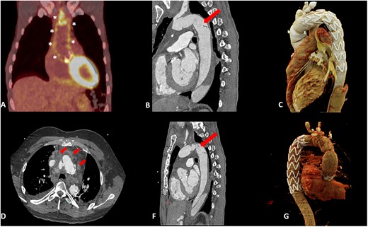 (A) PET-positive result along the aortic prostheses (*). (B and F) CT showing intimal damage of the descending aorta (arrow). (C and G) CT scan post TEVAR. (D) CT showing fluid collection (arrow).