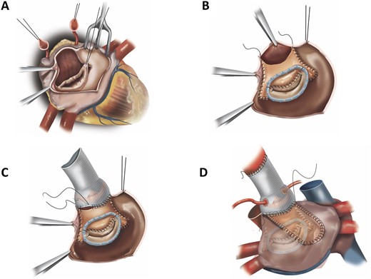 (A) En bloc resection of the area of confluence of the aortic root, the left atrial roof, the aorta mitral junction and the base of the anterior mitral leaflet with preservation of the free edge of the anterior mitral leaflet. (B) Reconstructed anterior mitral annulus and leaflet with a bovine pericardial patch folded upon itself. (C) Reconstructed left ventricular outflow tract after root replacement. The prosthetic aortic valve/root graft is anchored to the aortic annulus and neo-left ventricular outflow tract, as well as to the anterior limb of the pericardial patch. (D) Left atrial roof closure with a single pericardial patch.