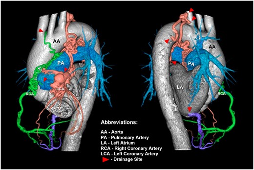 A 73-year-old patient with acute basal ganglia infarction was found to have rare and complex coronary artery fistulas through cardiovascular computed tomography angiography. The coronary artery fistulas exhibit multiple origins and drainage sites (red arrow), including pulmonary artery, aortic arch, left subclavian artery, left bronchial arteries and left atrium (Supplementary Material, Video S1).