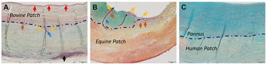 Microscopic images of selected luminal surfaces (Movat-Verhoeff stain). (A) Bovine patch with thrombus (red arrows). Black arrows point to lymphoid tissue. (B) Equine patch with pannus (turquoise staining) and patch fragments (yellow arrows) being transported towards the luminal surface (black dotted arrows) by macrophages (orange arrows)/foreign body giant cells (blue arrows). (C) Human autologous patch with non-inflammatory pannus. Blue dashed line indicates the patch-tissue borders in 2A–C.
