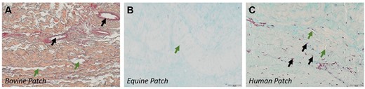 Appearance of pericardial patch materials. (A) Bovine patch; Collagen stained orange. Black arrows: remnant vessels. Green arrows: inter-collagenous spaces. (B) Equine patch with small gaps (green arrow) between collagen fibres (pale orange stain). (C) Autologous human patch. Black arrows point to nuclei; green arrows, to collagen gaps.